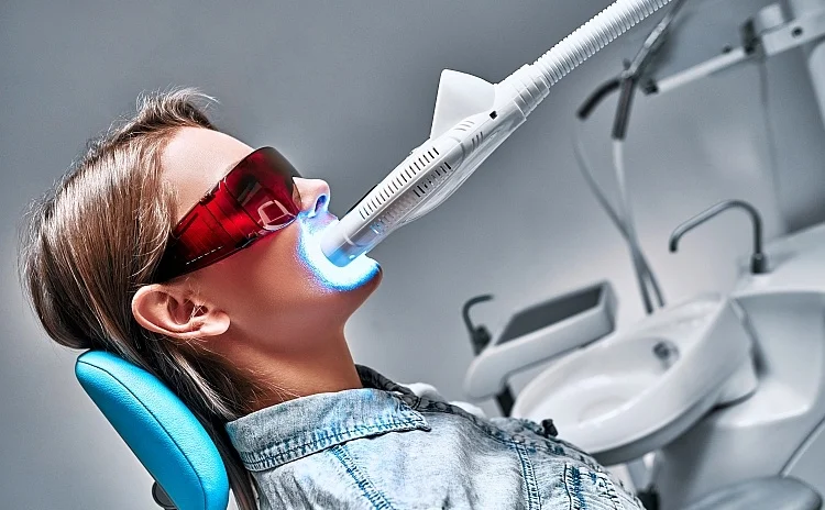 blanchiment-dentaire-2